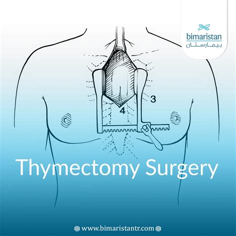 Thymectomy Surgery Options