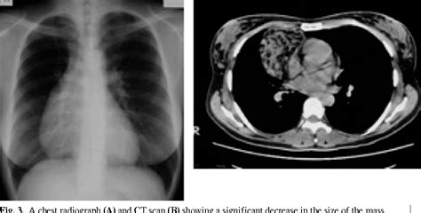 Thymic Hyperplasia Associated With Hyperthyroidism