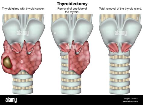 thyreoidektomie