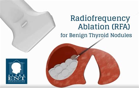 thyroid ablation vs surgery