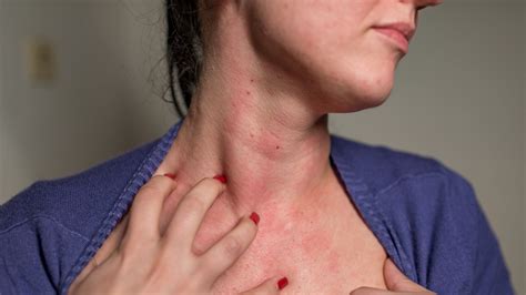 Thyroid Area Skin Redness