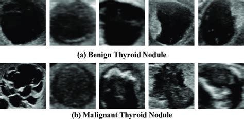 thyroid nodule benign vs malignant ultrasound
