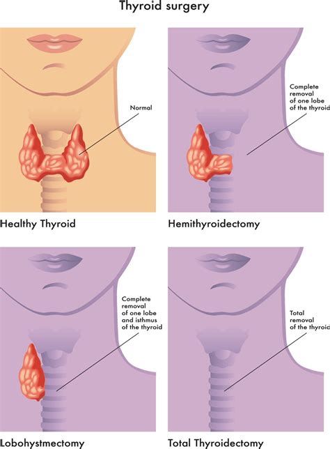 Thyroid Nodule Removal Surgery Uk