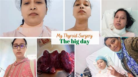 Thyroid Removal Surgery Youtube