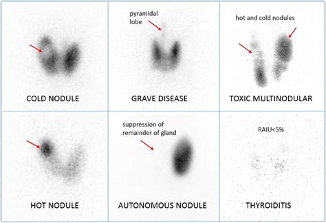 Understanding Your Thyroid Uptake Scan: What You Need to Know