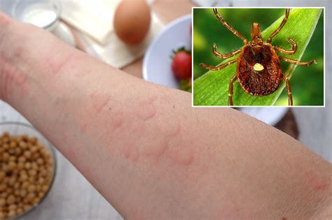 Tick Bite Meat Allergy: Uncovering the Hidden Health Risk