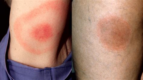 What Does a Tick Bite Rash Look Like: Identification and Treatment Options