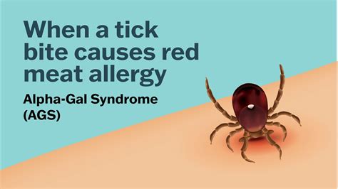 Red Meat Allergy from Tick Bites: A Hidden Danger