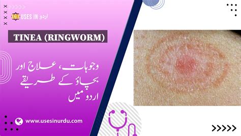 Fast Ringworm Solution Home Remedies For Ringworm Dhadar (Ringworm
