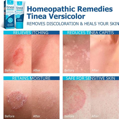 Effective Tinea Versicolor Medication: Top Treatments to Clear Skin Fast