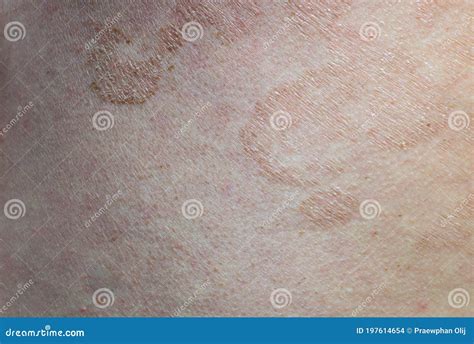 Tinea Versicolor Up Close