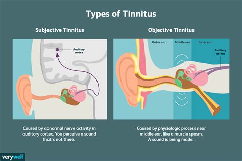 Tinnitus Que Es: Understanding the Causes and Solutions for Ringing in Your Ears