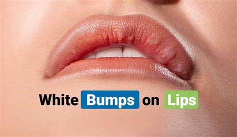 tiny white bumps on lips hpv