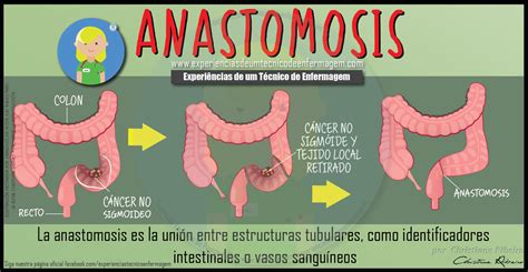 tipos de anastomosis intestinales