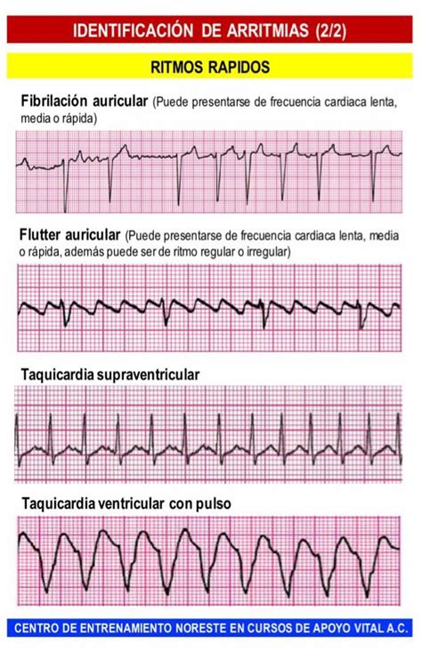 tipos de arritmias en el electrocardiograma