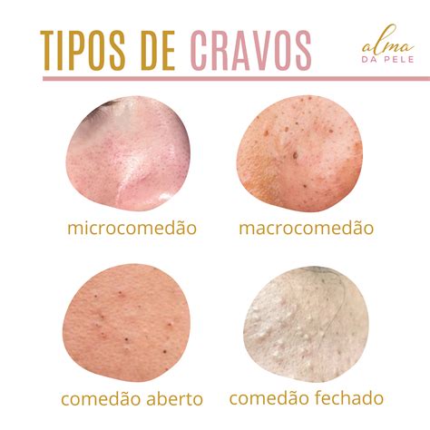 tipos de cravos na pele