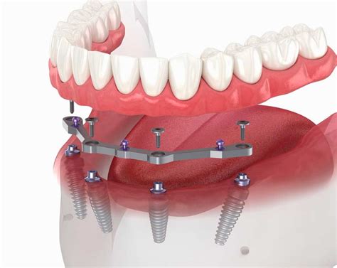 Titanium Bar For Dental Implants