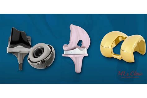 The KineSpring ® Knee implant System. Femoral base (A), absorber unit