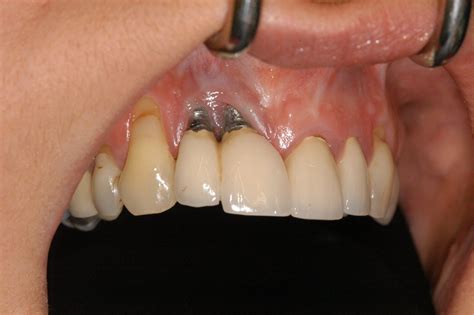 Titanium Dental Implant Problems