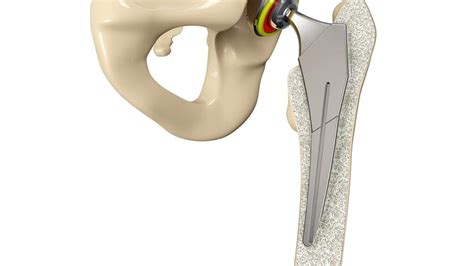 Titanium Hip Replacement Issues