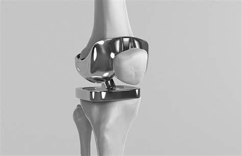 Titanium Knee Implants