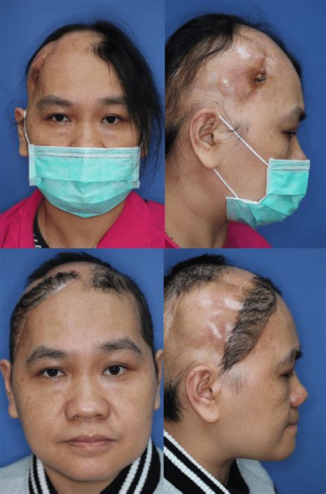 Titanium Plate In Arm Side Effects