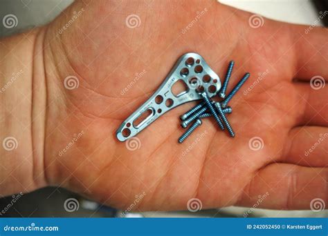 Titanium Plates In Wrist