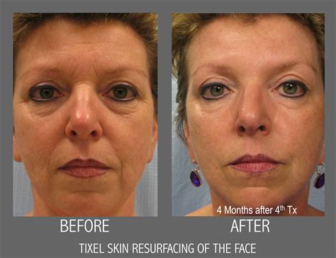 tixel treatment gone wrong