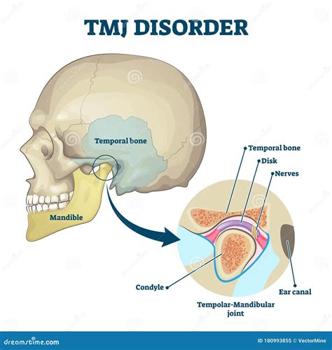 Temporomandibular Joint (TMJ) Disorder