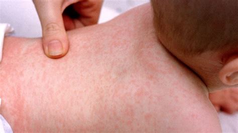 toddler itchy rash on back