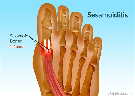 Toe Joint Pain From Running