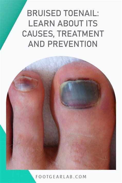 toe nail bruised