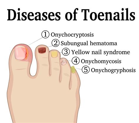 What to Do When Your Toe Nail is Coming Off: Causes, Symptoms, and Treatment Options
