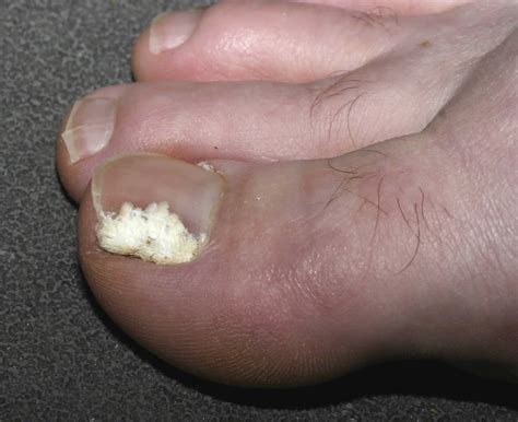 Effective Toe Nail Fungus Treatment: A Proven Solution Exists