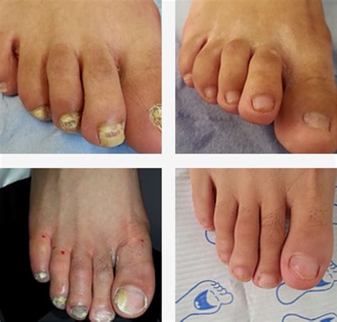 Toe Nail Removal Healing Process