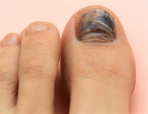 toe nail turning black and scaly