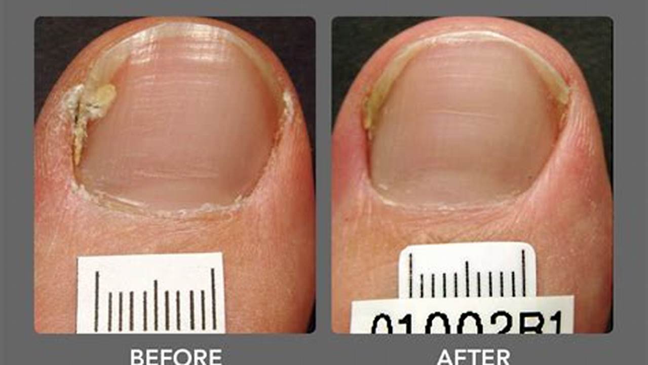 Toenail Fungus Laser Treatment Before and After