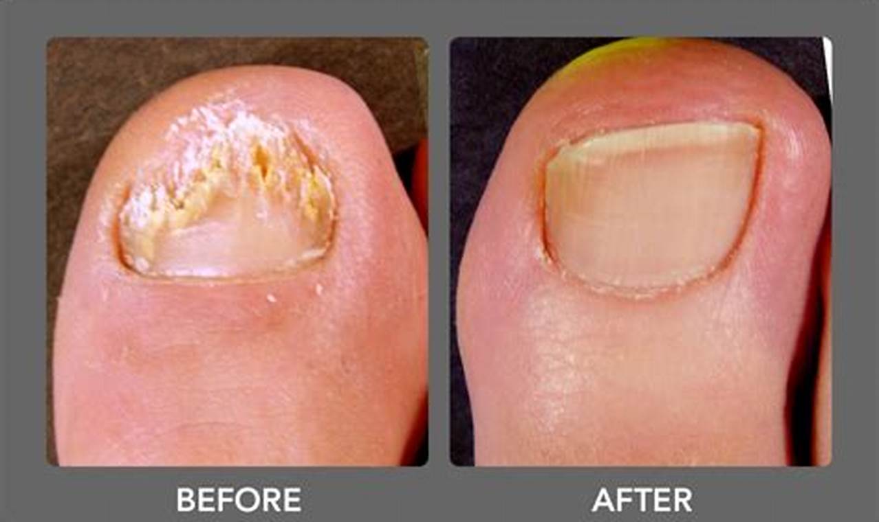 Toenail Fungus Pictures Before and After