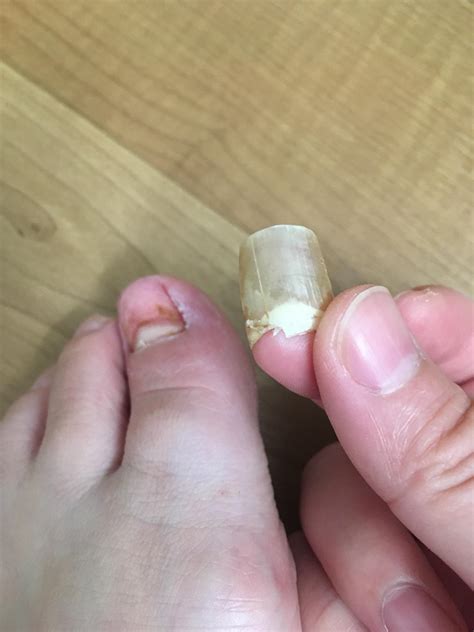 What to Do If Your Toenail Gets Ripped Off: A Step-by-Step Guide to Relief and Recovery