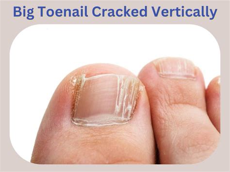 Toenail Splitting Vertically