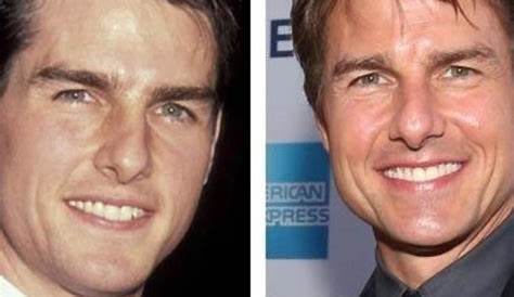 Tom Cruise Before Teeth Done / Stars Who Ve Brushed Up Their Smiles