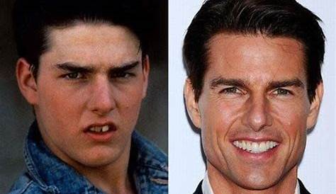 Tom cruise's teeth before and after photos and dental procedure — citiMuzik