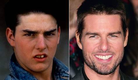 Tom Cruise's Teeth Before And After / Celebrity Veneers Before and