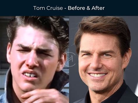 tom cruise dental work