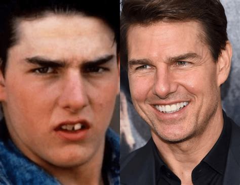 tom cruise old photos teeth