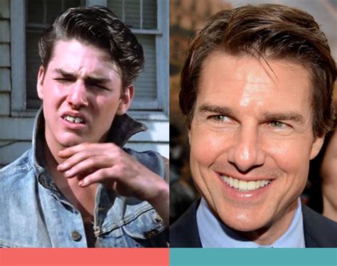 tom cruise with braces