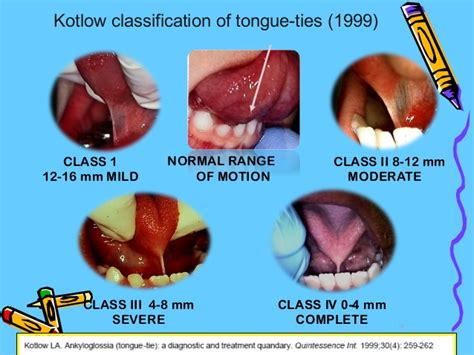 tongue and lip tie medical term