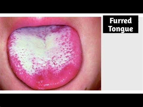 tongue furring