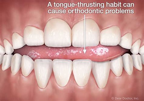 tongue pushing against front teeth