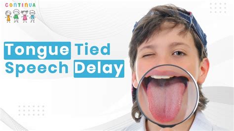 tongue tie and speech delay